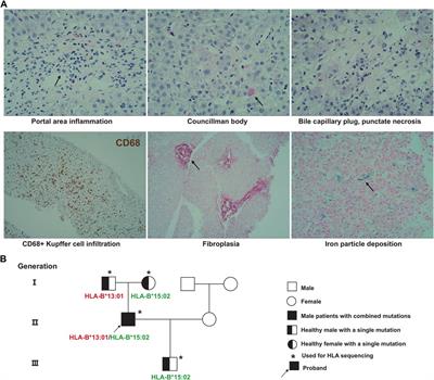 HLA-targeted sequencing reveals the pathogenic role of HLA-B*15:02/HLA-B*13:01 in albendazole-induced liver failure: a case report and a review of the literature